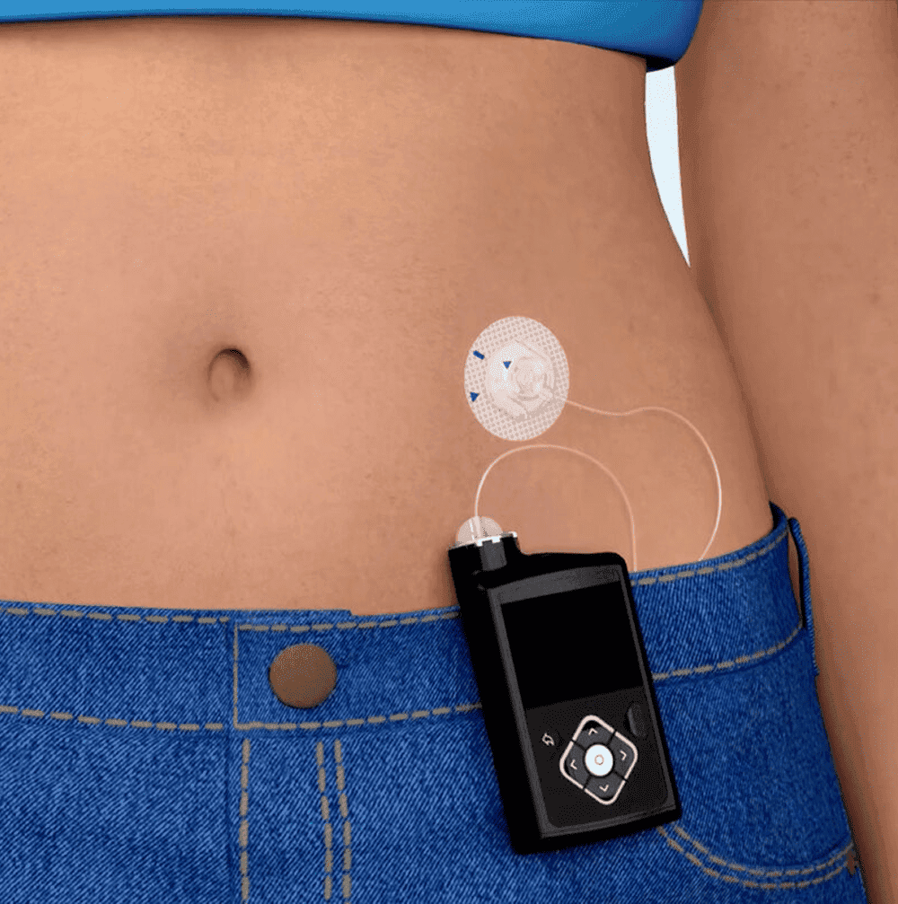 Insulin pumps and CGMs